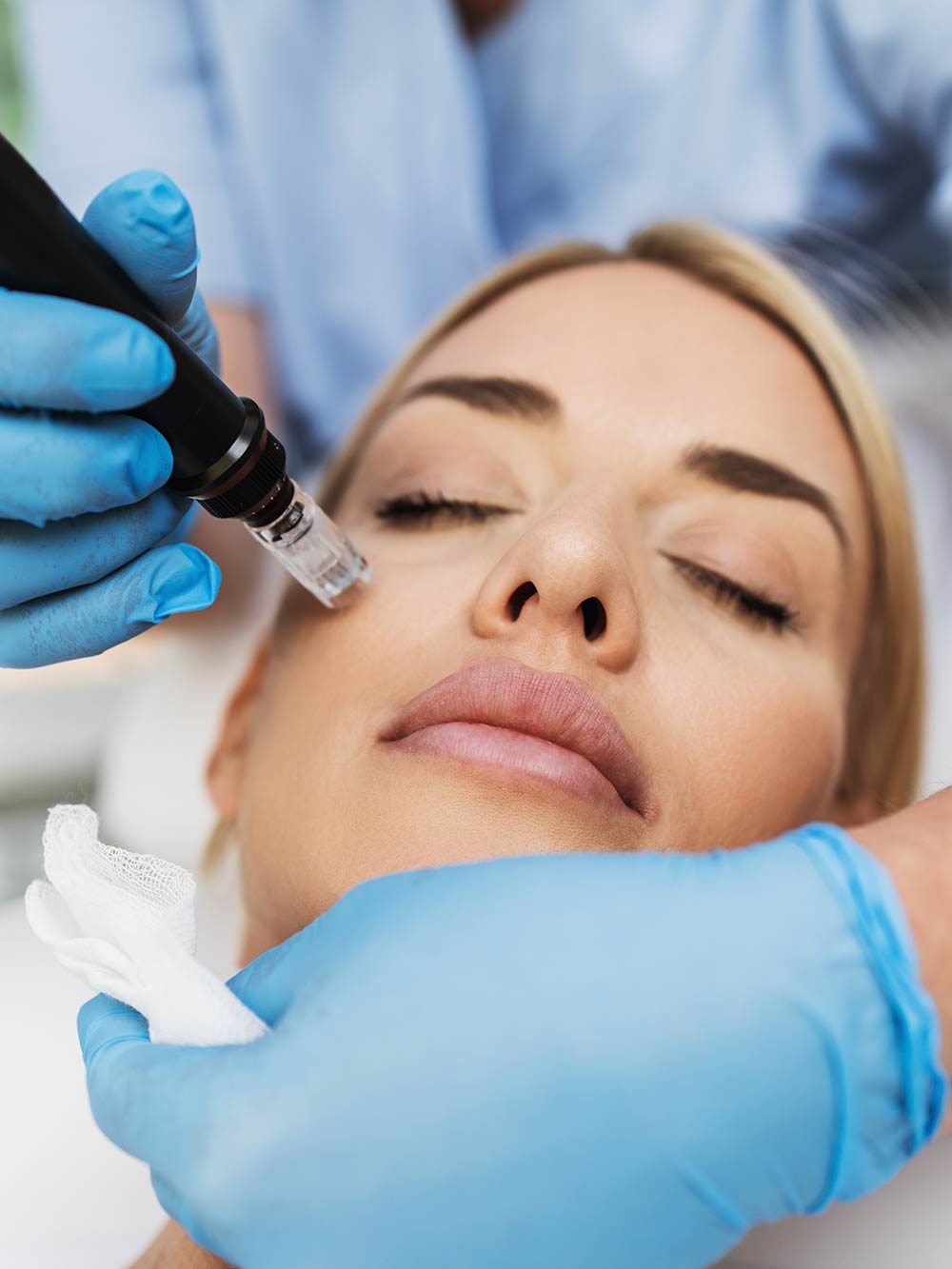 Microneedling FAQs